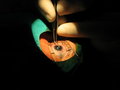 cataract surgery  recovery 