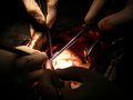heart valve replacement surgery survival rate