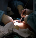 laparoscopic diverticulitis surgery 