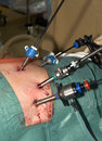 laparoscopic bowel resection surgery 