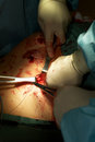 laparoscopic surgery how different traditional surgery